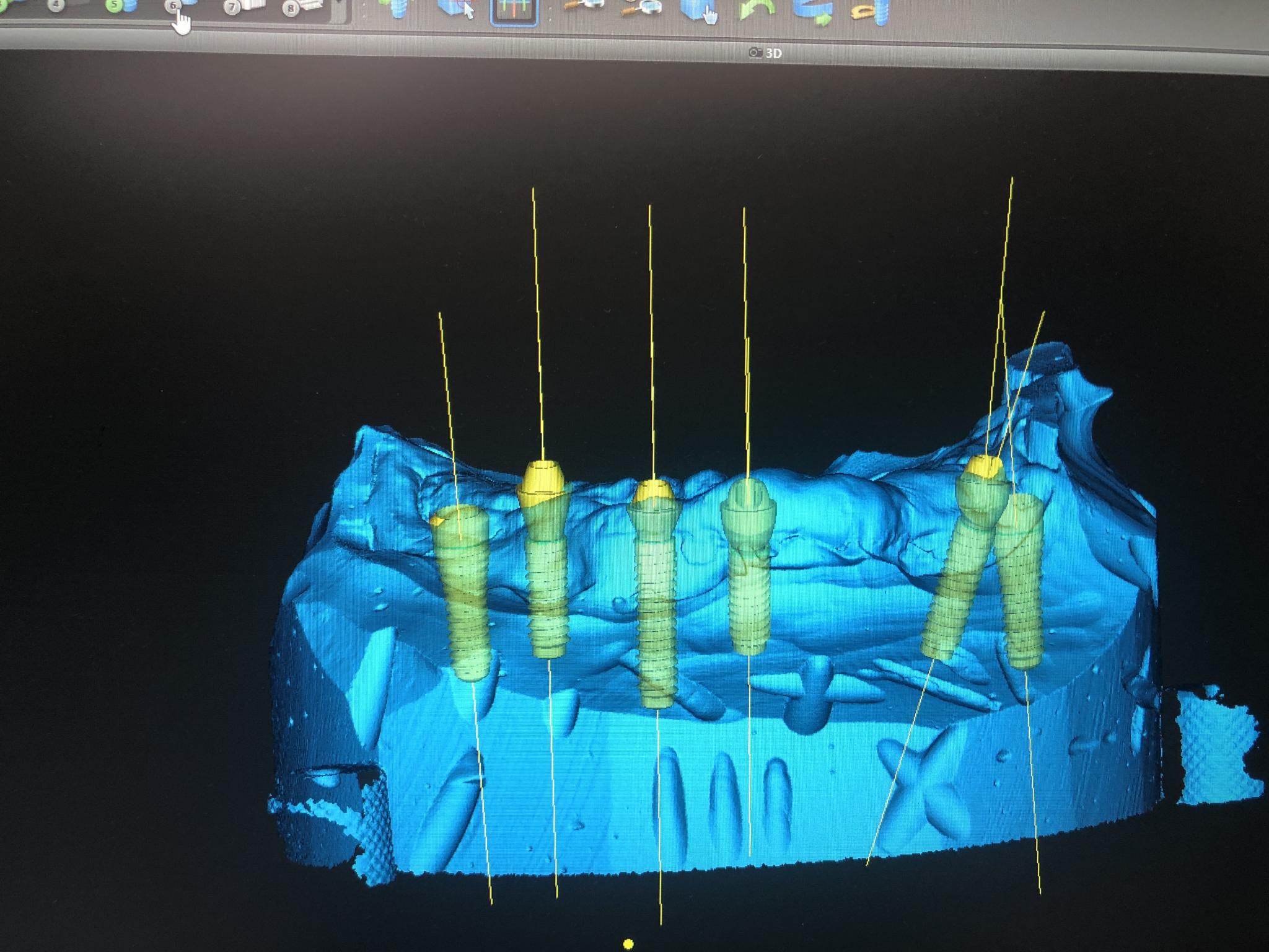 Reconstruction Sur 5 Implants Chrome Labor SRL