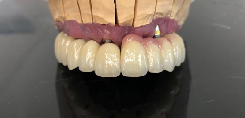 Reconstruction stratifié sur Zircone